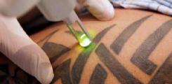 détatouage détatouage